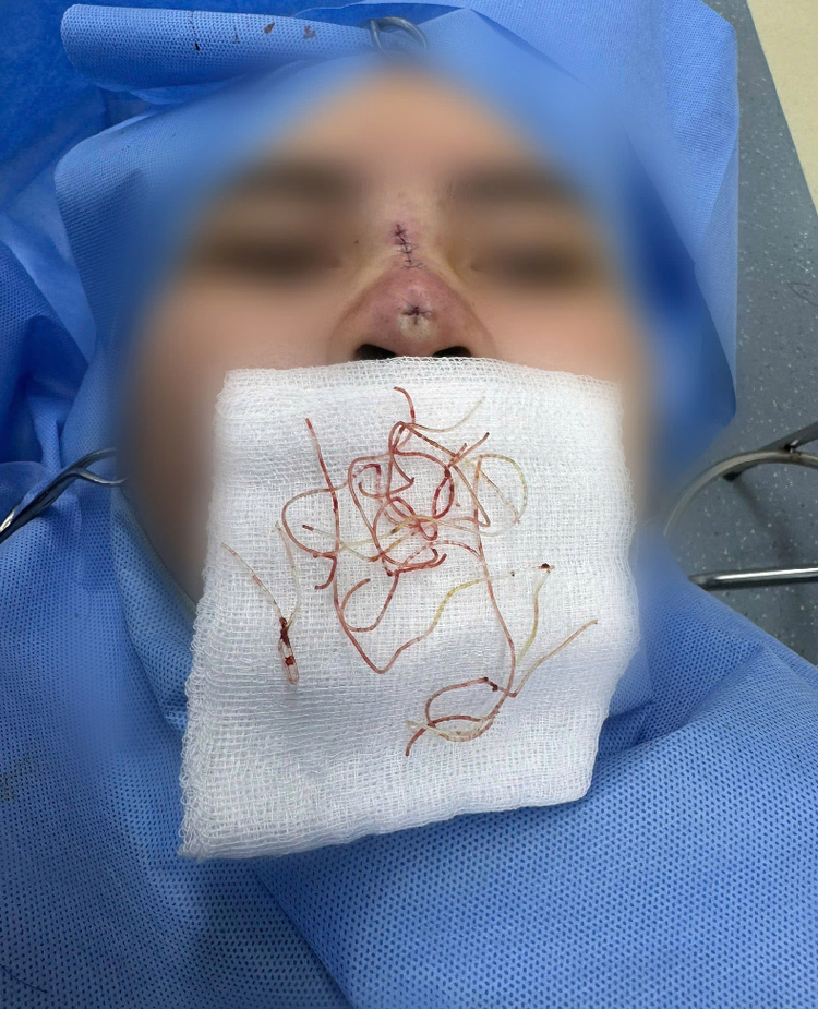 Bệnh nhân bị hoại tử mũi sau 3 tháng căng chỉ nâng mũi tại một cơ sở làm đẹp - Ảnh: BVCC