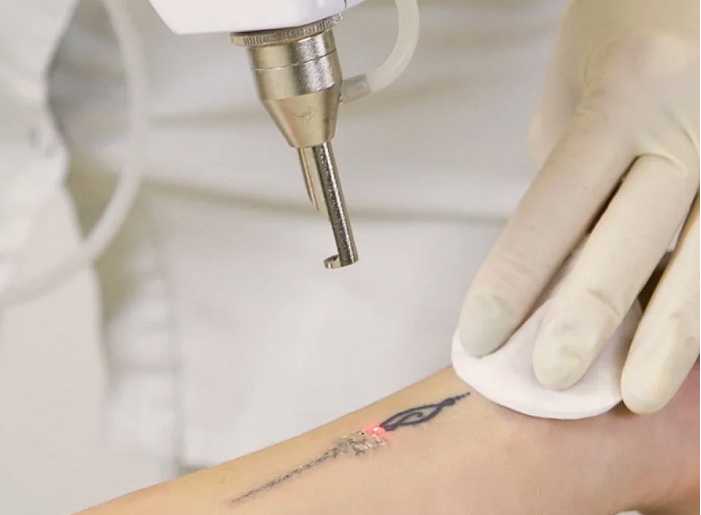 Xóa xăm có để lại sẹo không? - Ảnh minh hoạ