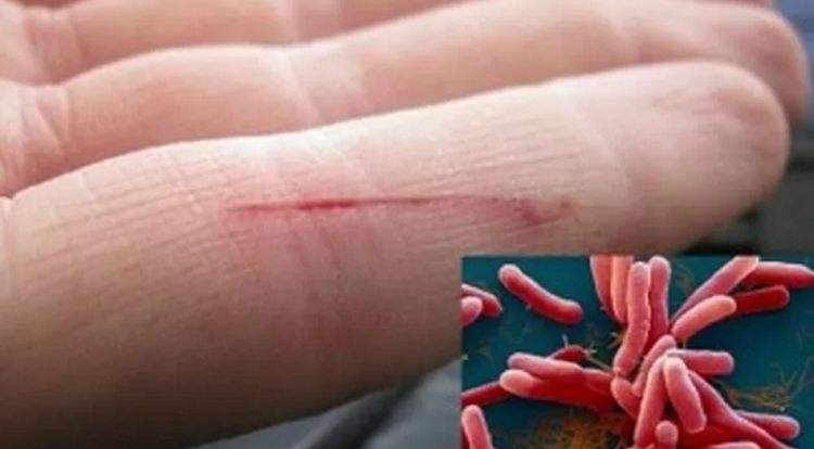 Bệnh Whitmore thường lây truyền qua tiếp xúc với đất, nước bị nhiễm khuẩn và thường xuất hiện ở bệnh nhân có sức đề kháng suy giảm - Ảnh minh hoạ