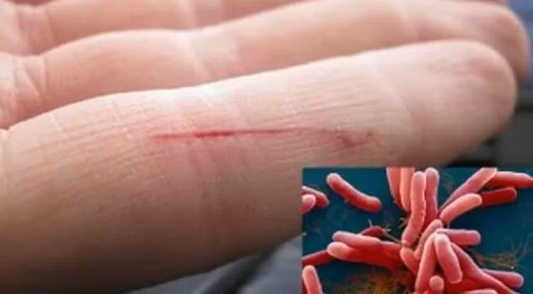 Bệnh Whitmore thường lây truyền qua tiếp xúc với đất, nước bị nhiễm khuẩn và thường xuất hiện ở bệnh nhân có sức đề kháng suy giảm - Ảnh minh hoạ