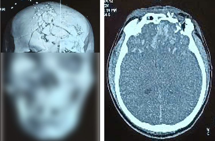 Hình ảnh phim Cắt lớp vi tính xương sọ và tổn thương não khi bệnh nhân nhập viện - Ảnh: BVCC