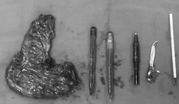 Bệnh phẩm bao gồm: Đoạn đại tràng Sigma và dị vật (bút, ngòi bút và tăm nhựa). Ảnh BV Bạch Mai