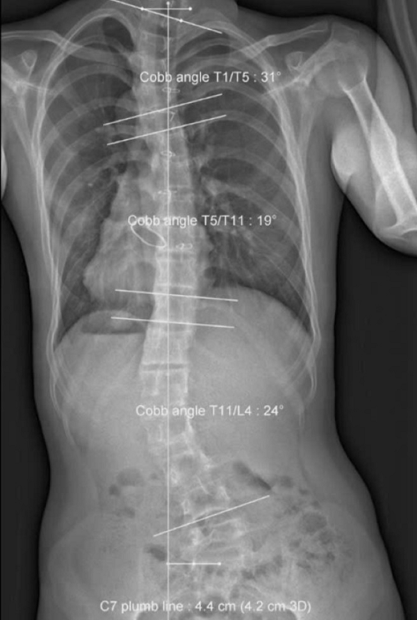 Ảnh chụp cột sống cho thấy bệnh nhân bị vẹo hình chữ S. Ảnh: BSCC.