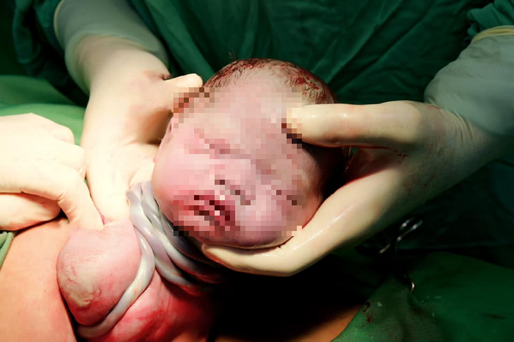 Bé gái chào đời với 9 vòng dây rốn cuốn cổ tại BV Phụ sản Hà Nội - Ảnh: BVCC