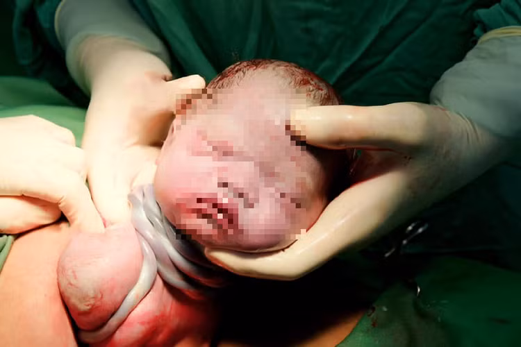 Bé gái chào đời với 9 vòng dây rốn cuốn cổ tại BV Phụ sản Hà Nội - Ảnh: BVCC