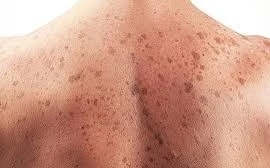 Dấu hiệu cảnh báo sớm ung thư da