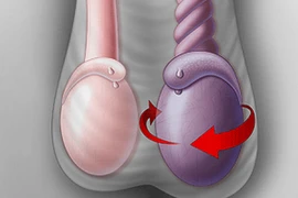 Cần phát hiện sớm xoắn tinh hoàn để tránh hoại tử