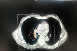 Điều trị ung thư phổi bằng phương pháp kết hợp hoá xạ trị mang lại hy vọng
