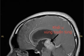 Thanh niên trẻ mắc u vùng tuyến tùng hiếm gặp được điều trị thành công 