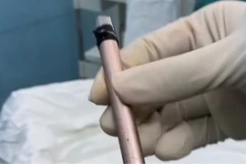 Dị vật bất ngờ trong bàng quang trẻ vị thành niên được xử lý an toàn