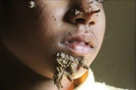 Việt Nam ghi nhận ca thứ hai mắc hội chứng 'người cây', bệnh nguy hiểm sao?