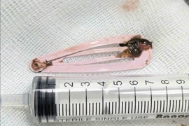 Bé 6 tuổi nuốt kẹp tóc kim loại nguy hiểm được cấp cứu kịp thời