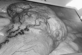 Bệnh nhân 60 tuổi cùng lúc phát hiện mắc 2 khối u ác tính