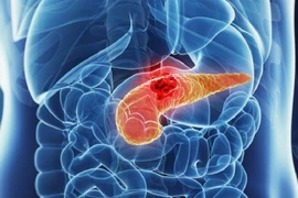 Quảng Ninh điều trị thành công viêm tụy cấp nặng do tăng triglycerid máu