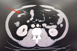 Người đàn ông thủng ruột non do dị vật tăm tre