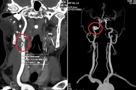 Phát hiện hẹp động mạch cảnh nặng đe dọa đột quỵ ở bệnh nhân tuổi trung niên