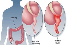 Số ca viêm ruột thừa tăng cuối năm, bác sĩ khuyến cáo đi khám sớm