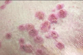 Nam bệnh nhân 33 tuổi dương tính với virus đậu mùa khỉ, chưa rõ nguồn lây