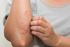 Mẹo phòng ngừa viêm da cơ địa khi trời lạnh