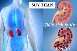 4 sai lầm nguy hiểm khiến bệnh thận tiến triển nhanh hơn