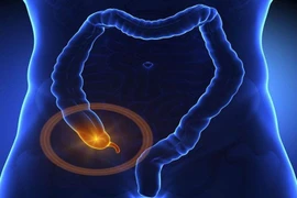 Ung thư ruột thừa hiếm gặp được phát hiện kịp thời trong phẫu thuật