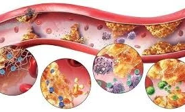 Triển vọng mới trong điều trị cholesterol cao bằng công nghệ gen