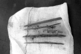 Nữ bệnh nhân phải nhập viện mổ cấp cứu do nuốt 3 tăm tre