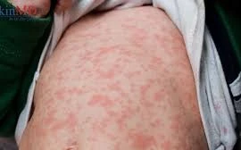 Cảnh báo trẻ nhỏ bị phát ban nguy hiểm dễ nhầm lẫn