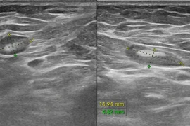 Phát hiện sớm ung thư vú ở người cao tuổi nhờ xét nghiệm giải phẫu bệnh