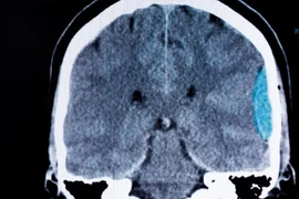 Cảnh báo đau đầu đột ngột có thể là dấu hiệu xuất huyết não