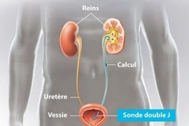 Bệnh nhân hơn 10 năm quên ống thông JJ trong cơ thể được lấy thành công