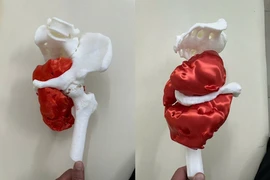 Ca phẫu thuật ung thư xương chậu hiếm gặp tại TP HCM