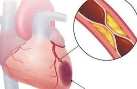 Cảnh báo về nhầm lẫn triệu chứng nhồi máu cơ tim và đột quỵ mùa lạnh