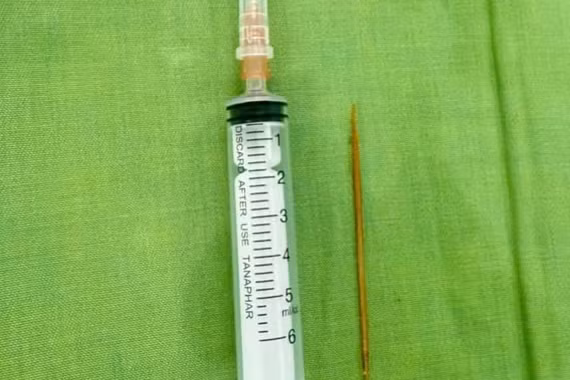 Sau 3 tuần nuốt tăm tre, bé trai 8 tuổi bị dị vật đâm xuyên tá tràng vào gan