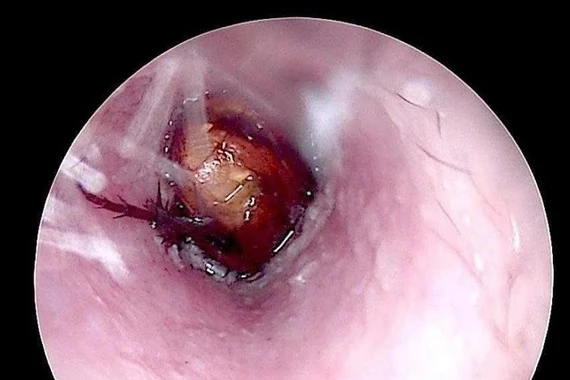 Côn trùng chui vào tai bệnh nhân ở Quảng Trị được gắp thành công