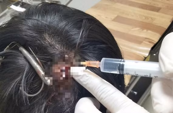 Nam sinh ở Quảng Trị bị móc câu 3 tiêu cắm sâu vào đỉnh đầu