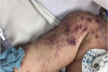 Một bệnh nhi tử vong do viêm não mô cầu nhóm B, có nên đổ xô đi tiêm phòng?