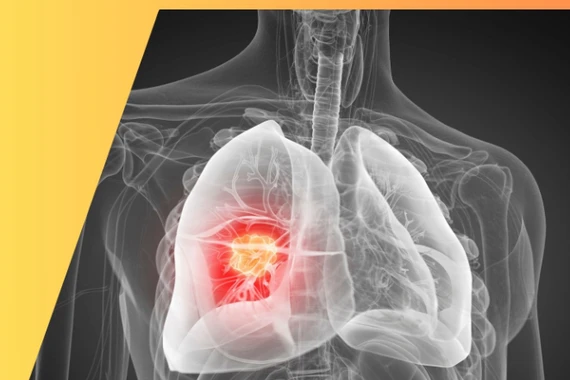 Bác sĩ chỉ rõ vai trò điều trị đích trong ung thư phổi