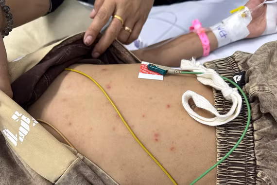 Cứu sống bệnh nhi 7 tuổi mắc não mô cầu type B