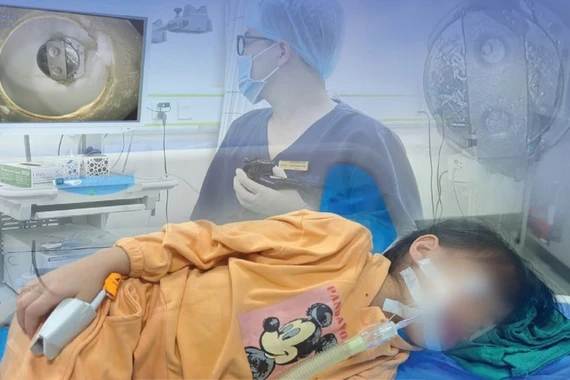 Đang vui chơi bé gái 7 tuổi nuốt phải dị vật mắc tại dạ dày
