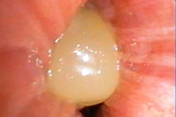 Ăn ngô bị sặc, người phụ nữ 60 tuổi suy hô hấp nguy kịch