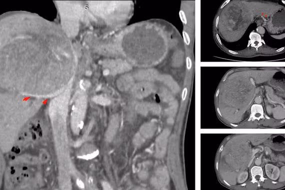 Hành trình giành sự sống cho người bệnh ung thư gan 'tiên lượng 9 tháng'