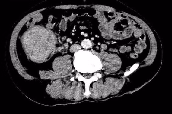 Mệt mỏi, đi ngoài phân đen không ngờ ung thư đại tràng di căn gan