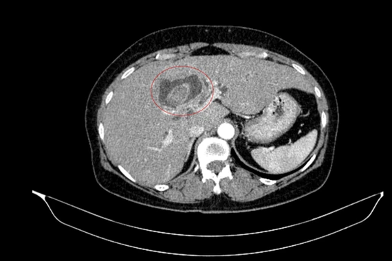 Vàng da người phụ nữ đi khám, phát hiện ca bệnh hiếm, hai ung thư nguyên phát
