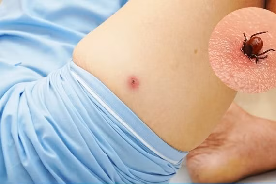 Sốt cao, ho nhiều không ngờ hỏng gan, phổi do mò đốt