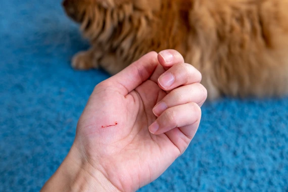 Bệnh nhân 71 tuổi tử vong vì chủ quan với vết mèo cào