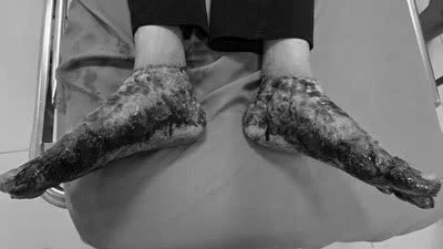 Ngâm nước lá nóng điều trị viêm da cơ địa, người bệnh bị bỏng nặng hai chân