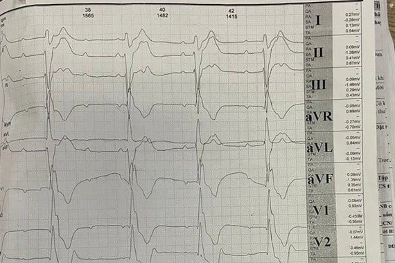 Cao gầy, sụp mí mắt, chàng trai 19 tuổi mắc hội chứng Kearns–Sayre hiếm gặp