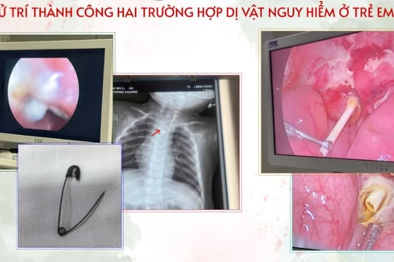 Thích ăn kẹo mút, trẻ viêm phúc mạc nặng vì que kẹo đâm thủng tá tràng