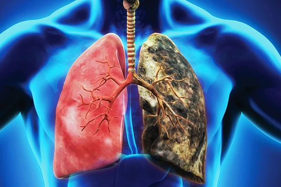 Mỗi điếu thuốc là kho chứa độc tố với hơn 7000 hóa chất, 70 chất gây ung thư